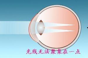 成人如何检测散光视频